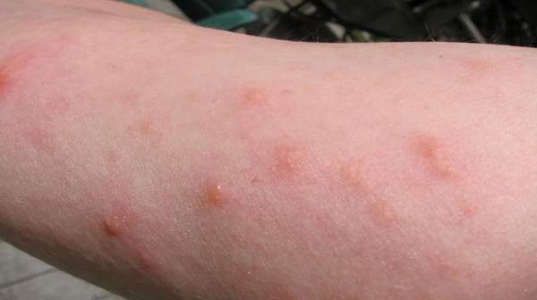 Pictures of Poison ivy rash