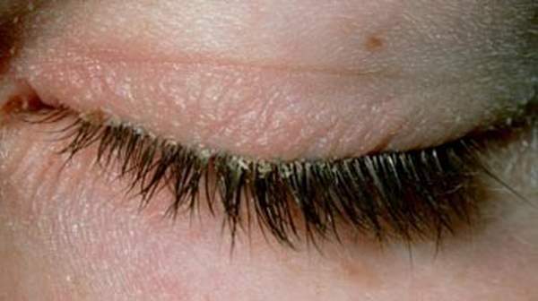 picture of Blepharitis