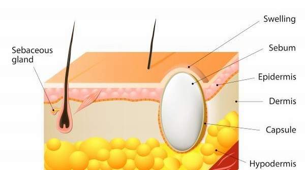 picture of Sebaceous-Cyst