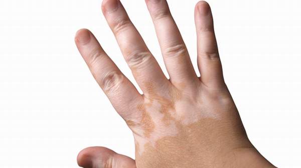 picture of Vitiligo