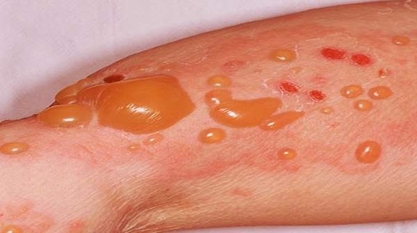 picture of bullous-pemphigoid