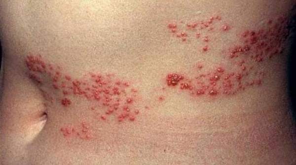 Picture of HIV rash on Common Early Symptoms