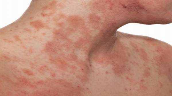 Eczema: Causes, Symptoms and Treatment