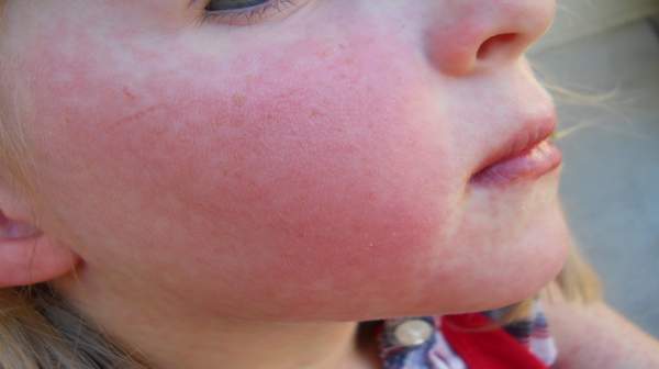 Red, dry rash around mouth? - Dermatology - MedHelp