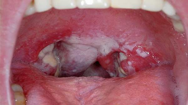 Strep throat rash Tonsils