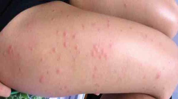 Dermatitis symptoms, types and treatment: Contact, atopic ...