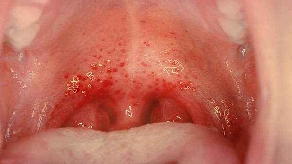 Pictures of Pharyngitis Symptoms, Contagiou