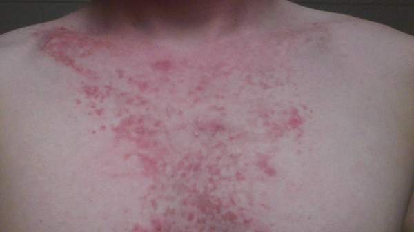 itchy chest rash