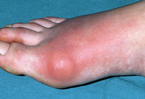 ... gout, but women become increasingly susceptible to gout after