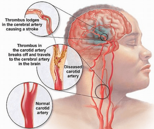 Artery