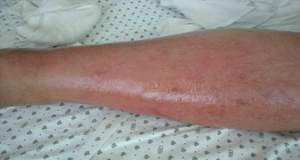 Cellulitis is fairly common