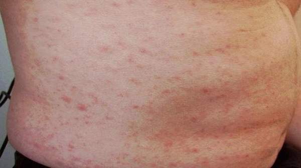 Folliculitis Symptoms, Treatment - virtuwell Online Clinic