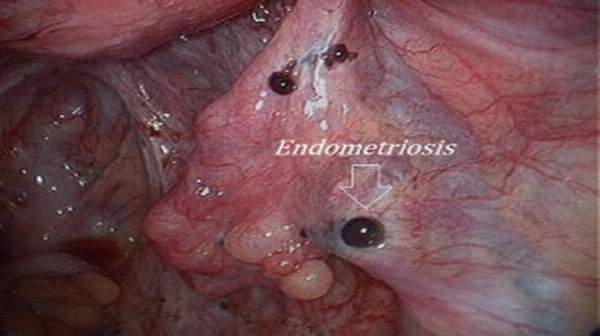 Endometriosis