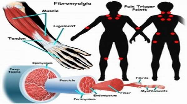 Fibromyalgia