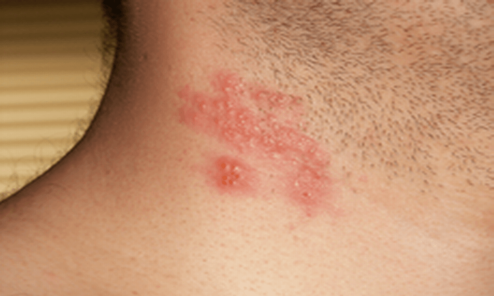 Herpes Zoster Pictures, Images & Photos | Photobucket