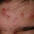 Nodular Acne Signs