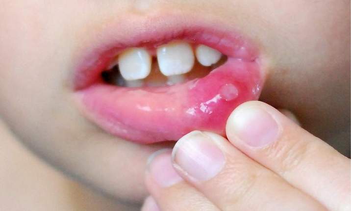 Mouth sores: MedlinePlus Medical Encyclopedia