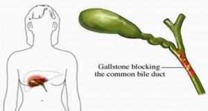 Gallbladder pain is generally caused by biliary colic, cholecystitis, gallstones, pancreatitis, and ascending cholangitis.