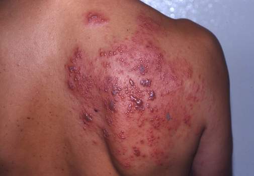 Skin Rash: 59 Pictures, Causes, Treatments - Healthline