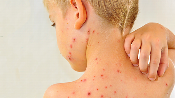 Measles: Symptoms, Diagnosis & Treatments