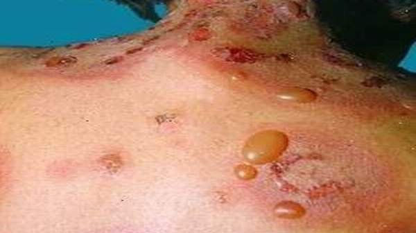 Bullous Pemphigoid