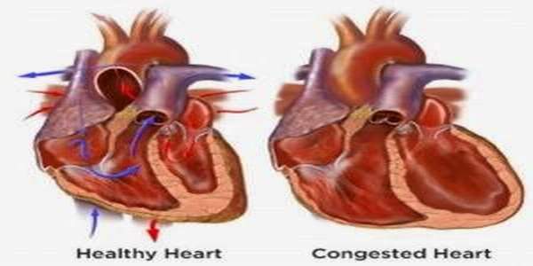 Congestive Heart Failure