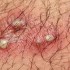 Genital herpes, herpes, herpes simplex virus, Symptoms of genital herpes, treatment for genital herpes