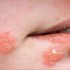 Herpes Simplex, Symptoms of Herpes Simplex, treatment of Herpes Simplex, HSV, HSV-1, HSV-2