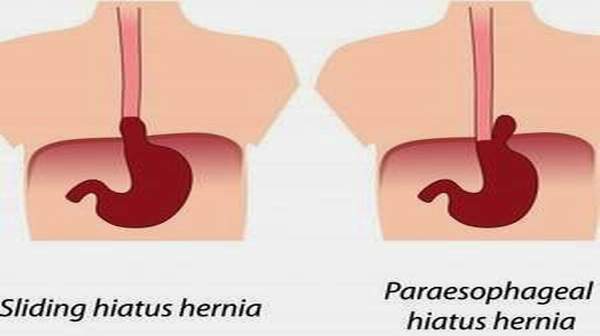 Hiatal Henia