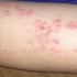 Non itchy rash can rise fever up to 103°F, NONINFECTIOUS RASHES, CAUSING THE RASH