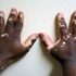 Vitiligo, melanocytes, skin discolor