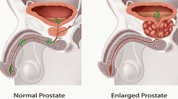 Enlarged Prostate Affects Older Men