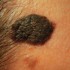 Seborrheic Keratosis, ,Causes of Seborrheic Keratosis, Symptoms of Seborrheic Keratosis