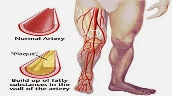 Blood Vessel Disease is The Leading Cause Of Amputations