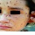 Chickenpox, Varicella,