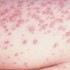 Histoplasmosis occurs primarily on infants