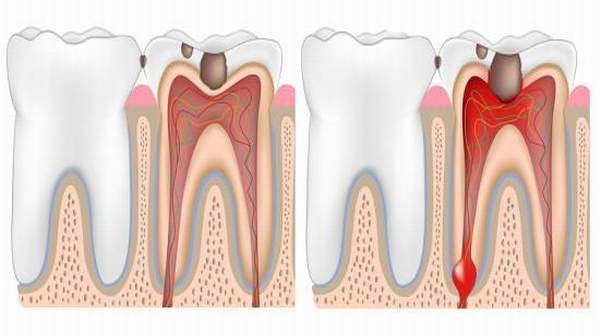 Toothache Treament