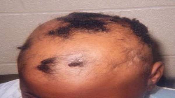 Classifications Of Alopecia