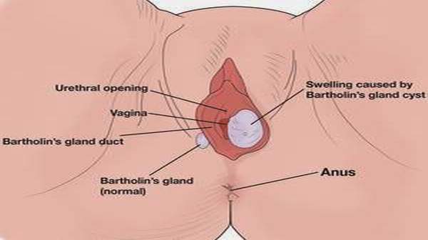 Benign vaginal cysts and lesions