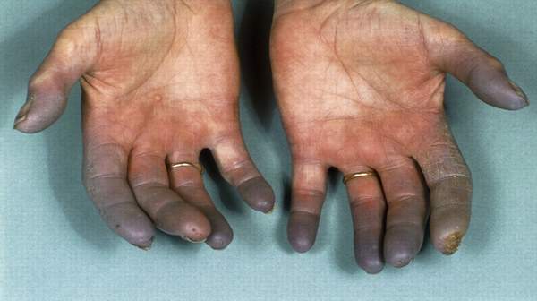 Buerger's Disease