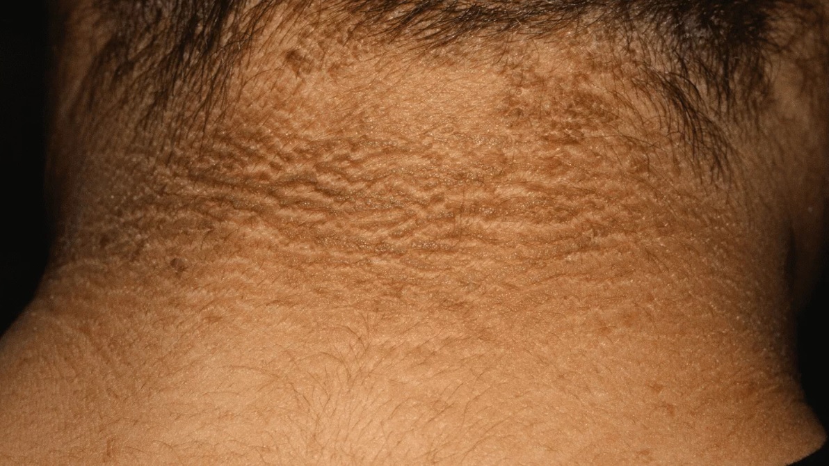 Can Acanthosis Nigricans be Prevented