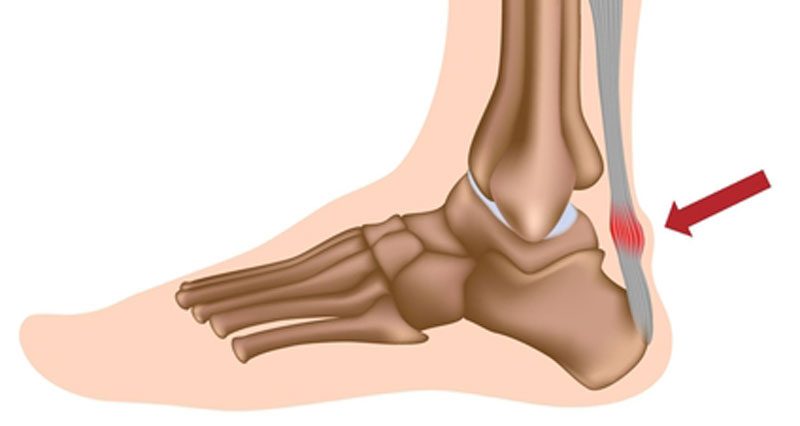 Preventing Achilles Tendonitis