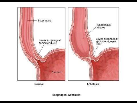 Achalasia: Definition, Causes, Symptoms, & Treatment