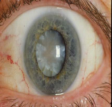 How Are Cataracts Treated