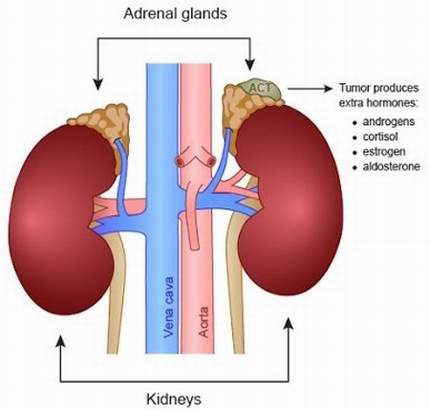 What is Primary aldosteronism?