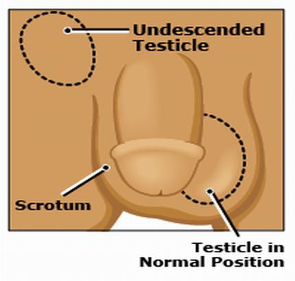 What usually causes Undescended testicle