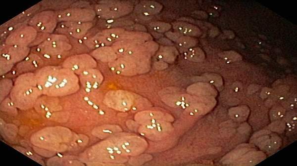 patient with Familial Adenomatosis