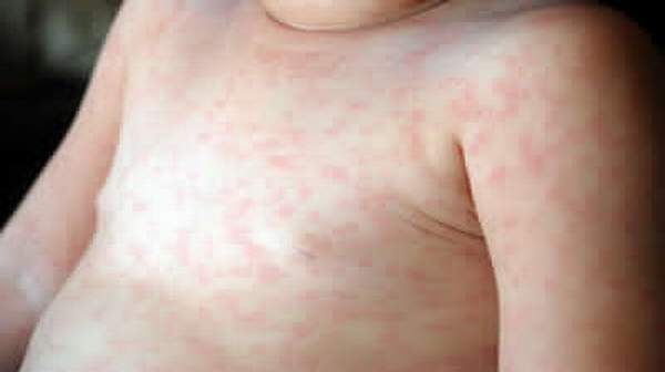 Picture of Roseola Infantum in Children