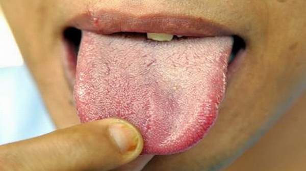Picture of White tongue