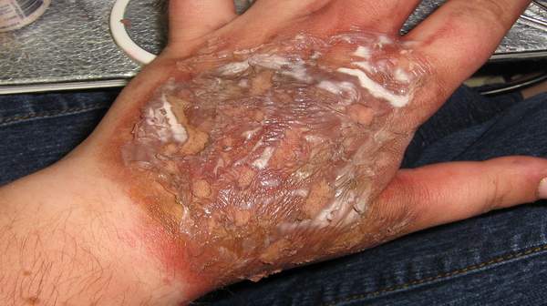 Picture of Chemical Burn